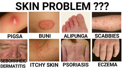 Skin allergy katikati na may tubig sa loob